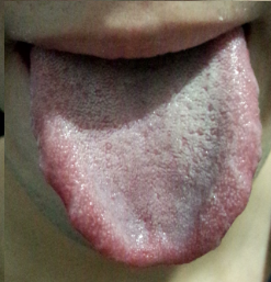 口干舌燥,舌苔发白,怎么办?