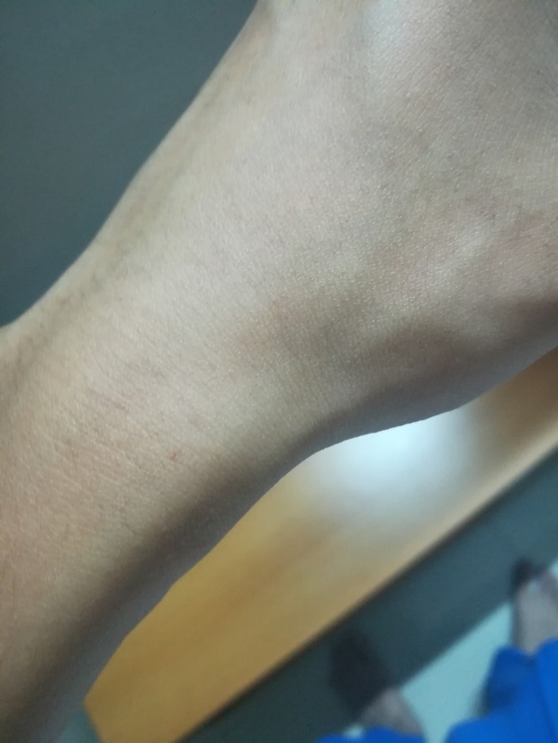 手上最近长了些好像小血点的红点 在皮肤底下