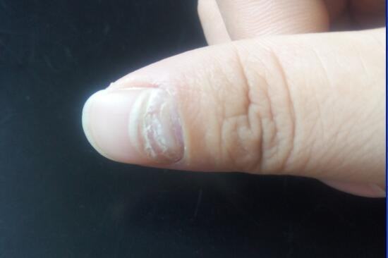 大拇指指甲根部开始长得凹凸不平,是什么原因