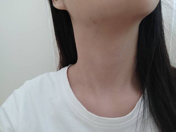 请问下巴下面和边缘长痘是什么原因呢?有图