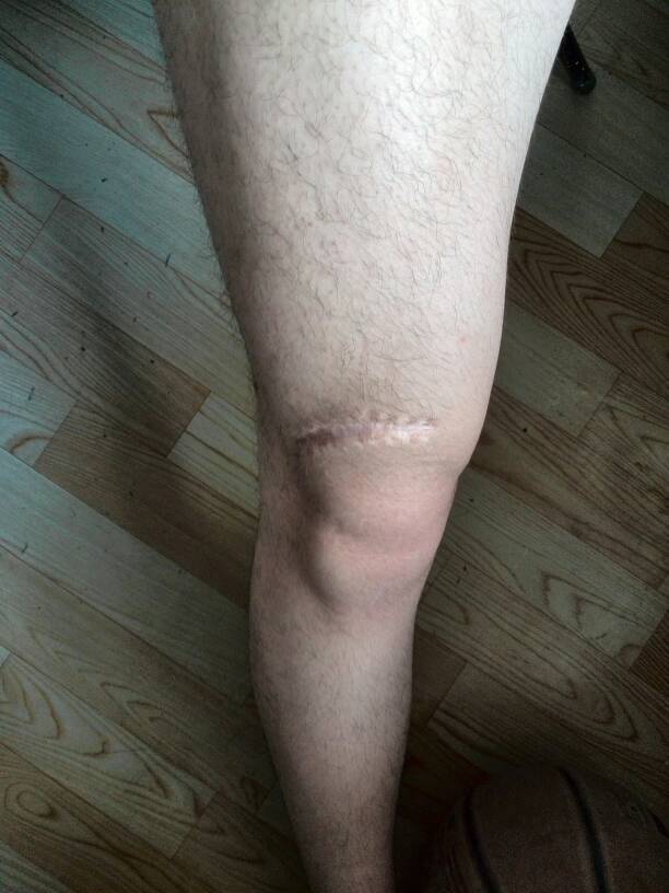 膝盖上方的疤痕,我报的空乘专业,形体,外贸都过了,现在就怕这个疤的