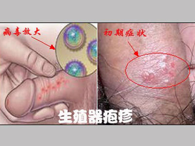 疾病常识 花柳病具体包括哪几种病 360新知