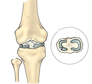 右膝关节内侧半月板后角损伤,膝关节伸直疼痛