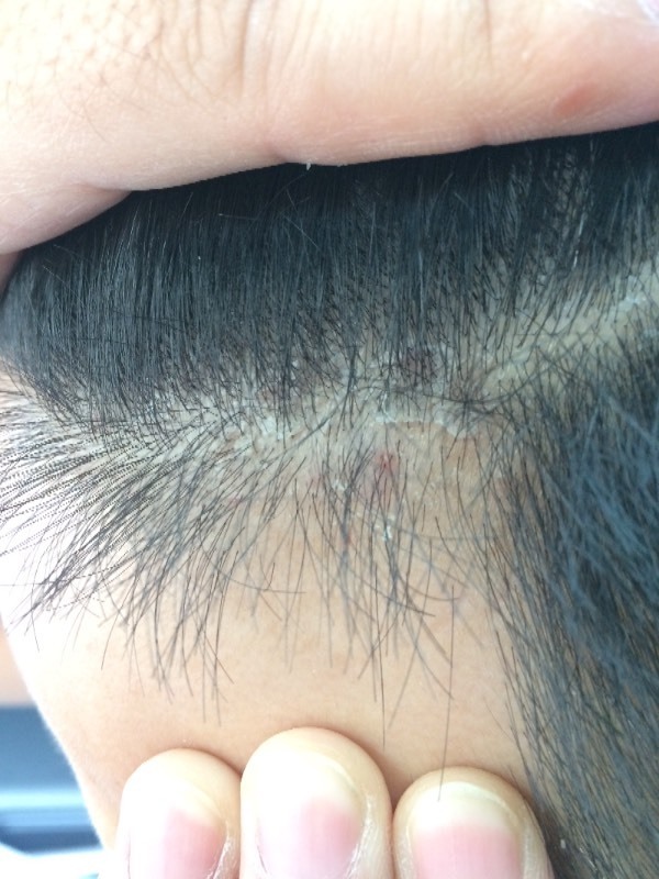 最近头皮屑扰人,经常是在头皮上的一大块,有人知道怎么破吗?