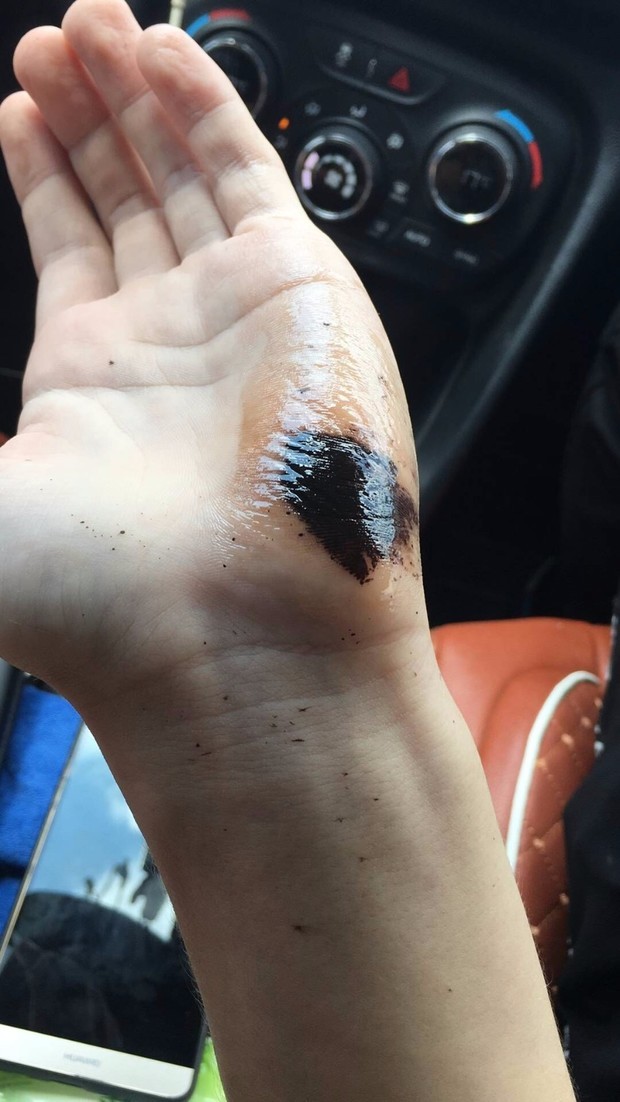 在变黑,刮掉黑色的皮,里面的肉的颜色又是正常的,没有痛感,是氢氟酸么