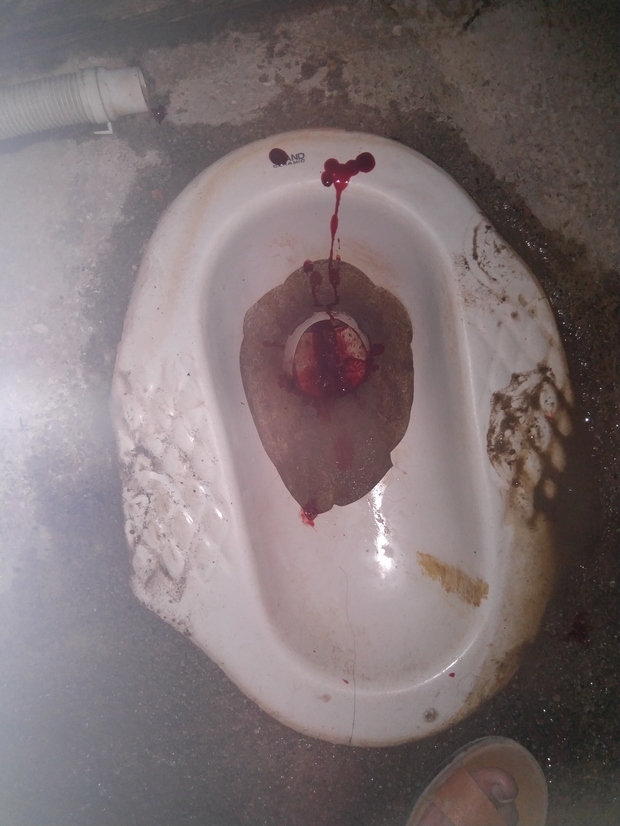 上厕所拉屎出大量的血