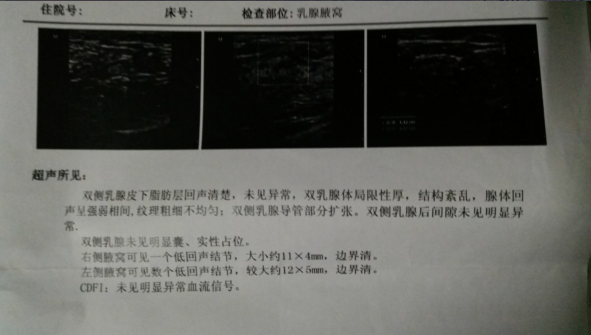 双侧乳腺BI-RADS II级; 双侧腋窝低回声结节,考