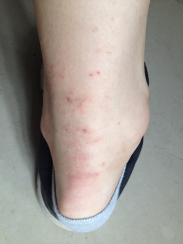 脚踝周围和膝盖上长了很多小痘,很痒。开始只