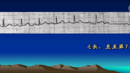 [图]心电图速成讲授（5）