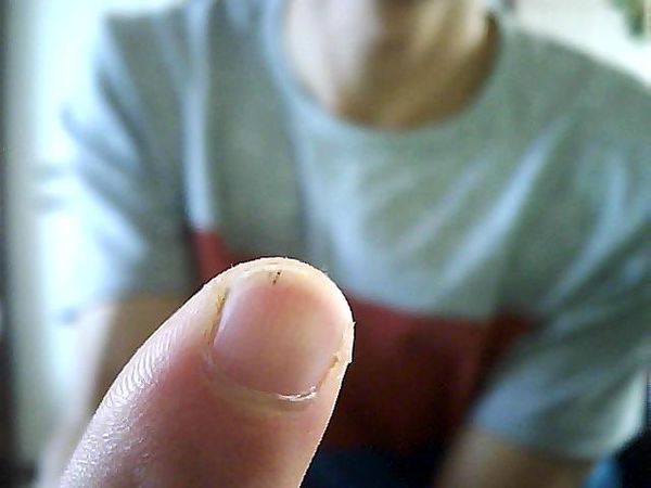 最近发现右手大拇指和食指外端里面有几条小黑线,最长的在3毫米左右