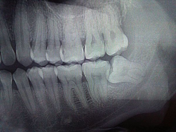 苏州第一人民医院可以拔水平阻生(智齿)牙吗?