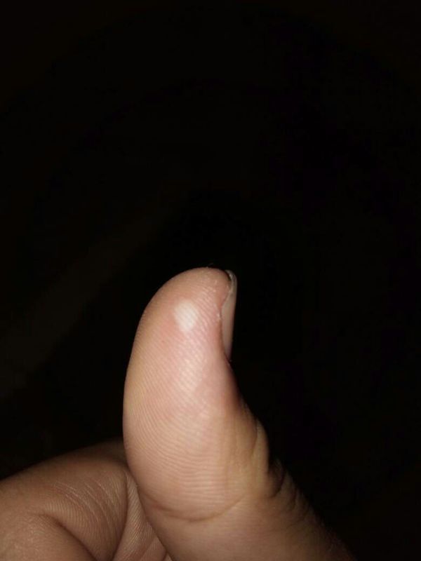 我是初学,练右手拨弦,其他手指还好,就是右手大拇指特别疼,怎么办