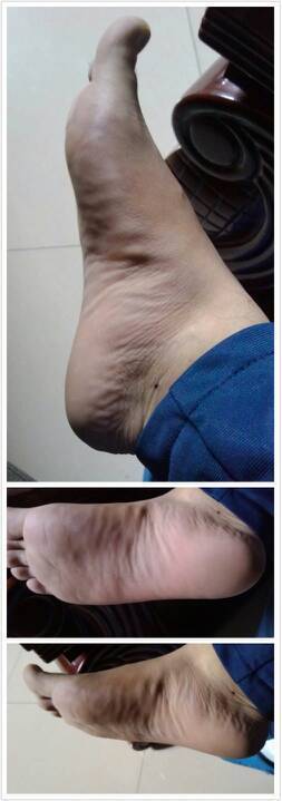 各位跑步高手帮我看看我的脚是内翻还是外翻?