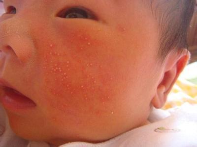 宝宝湿疹图片初期症状图片