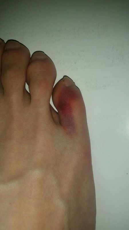 脚趾被砸拉一下,刚开始有点疼,没注意,我还出去走拉2公里,回来睡拉