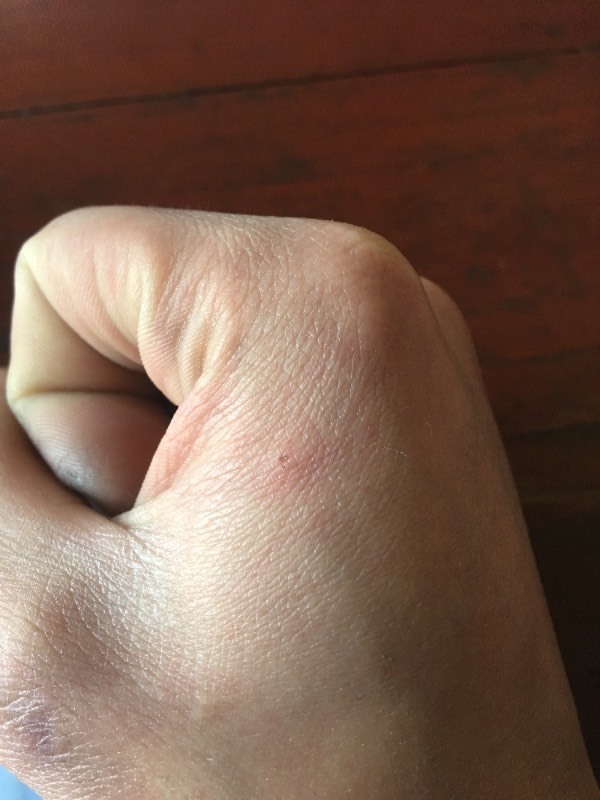 昨天被半个多月的小奶狗抓了,破了点皮今天才在意,我小时候打过狂犬