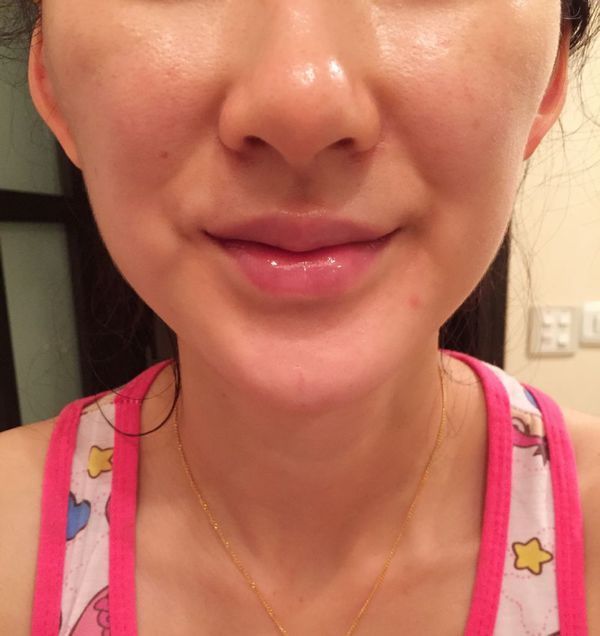 我是第一次打瘦脸针,过了三周了,突然这几天成了葫芦脸(颧骨和咬肌