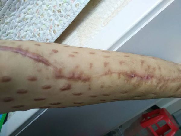 我老婆腿骨折做手术留下的疤痕,说有点增生啦还有点斑痕体质.
