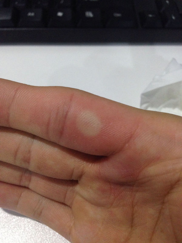 请问我的手怎么了?总是半夜三点痒醒,晚上非常