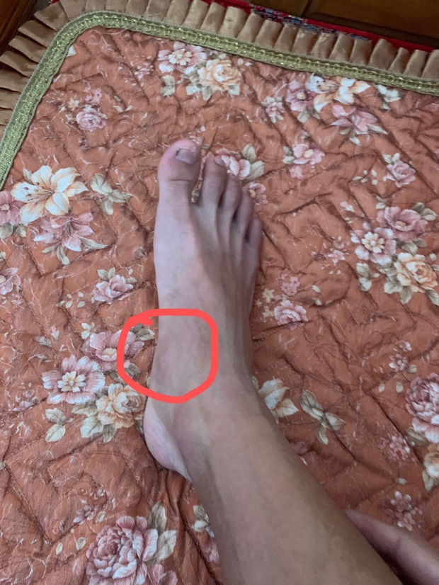 本人几个月前打篮球扭伤脚,此处一直痛,请问需要怎么样治疗?