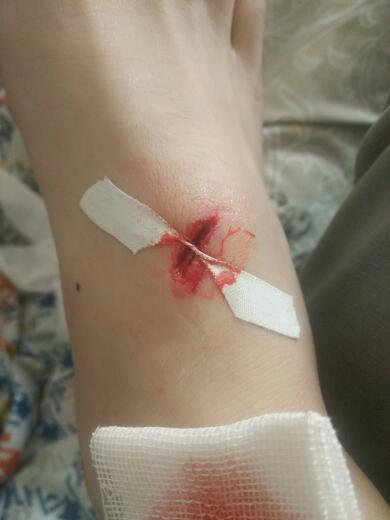 脚背被磨光机磨掉一块肉,不知脚经是否断了