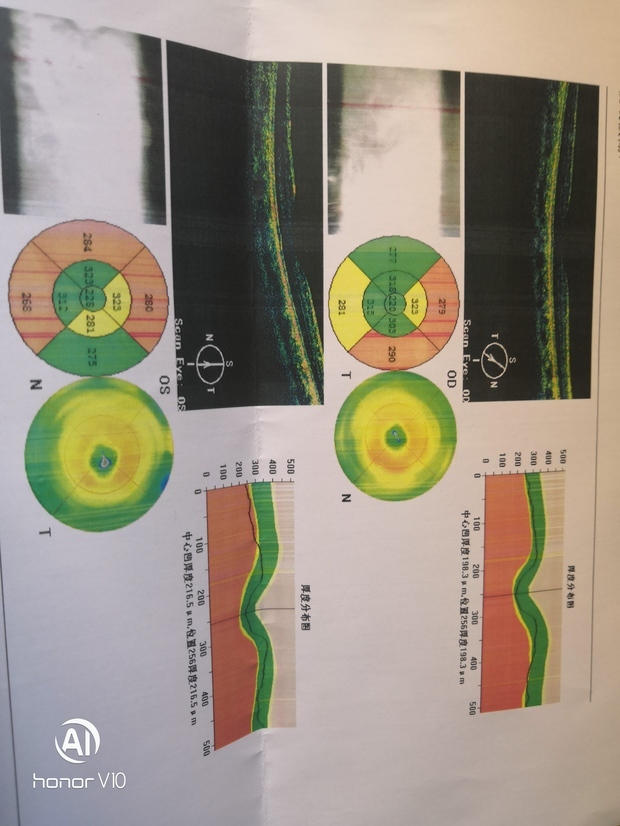 眼科oct图文报告
