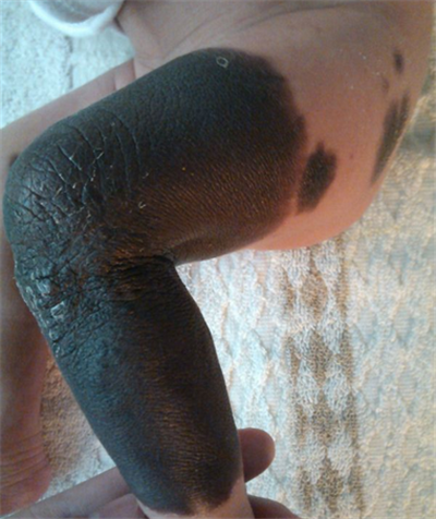 兽皮痣是怎样形成的?