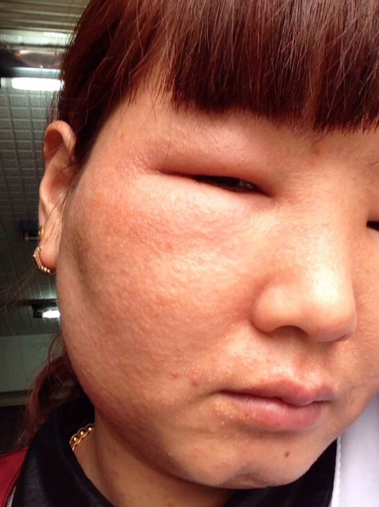 我姐姐卖了一知名品牌的化妆品,结果只用了一次就严重的过敏了,差点倒