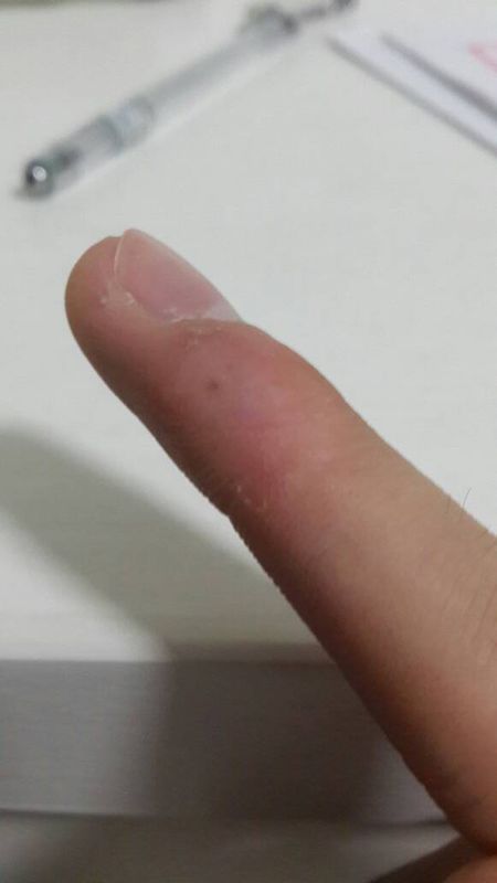 右手经常写字现在中指想了一个这样的东西一个包,要怎么消除?