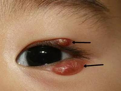 长针眼如何快速祛除?