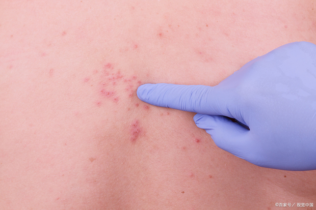 蛇缠腰是什么病,怎么治疗?