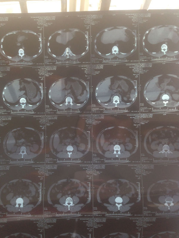 左腎一直疼了2個多月,斜身,側身,用手按壓也痛,睡覺有時壓迫也疼,在