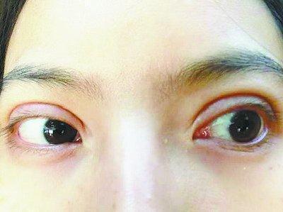 可以给一张鱼泡眼的照片看一下吗