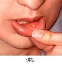 口疮的治疗方法及图片?