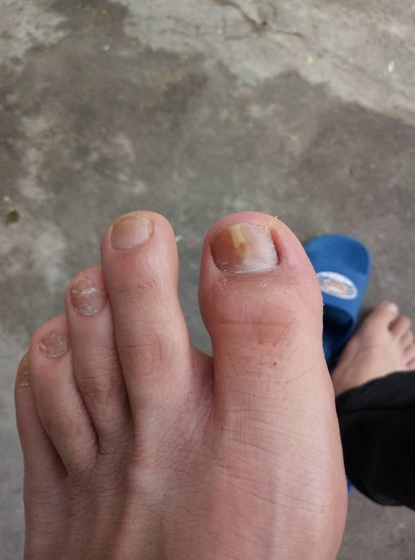 左脚指甲白色竖纹怎么回事?