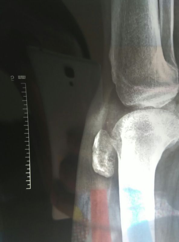 髌骨骨折保守治疗46天石膏外固定已经拆了,膝