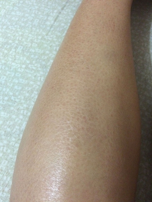 问:有鸡皮肤蛇皮肤起皮不光滑细腻怎么办?