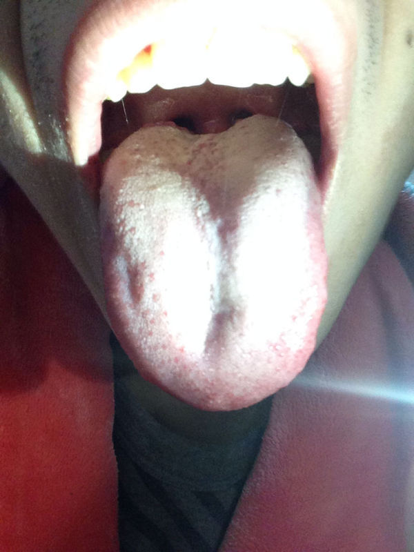 请问舌根后面有肉疙瘩突起是什么东西呀?上网