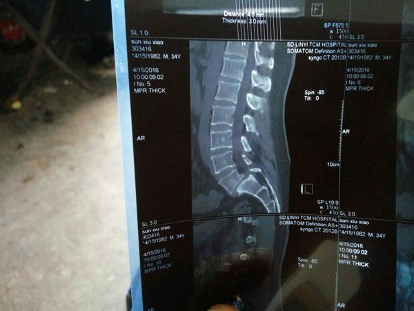 临沂市中医院做腰脊椎滑脱手术,技术怎么样,好