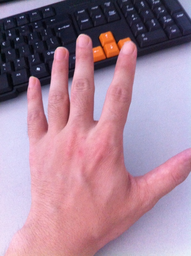 手藓【也就是大家说的鹅掌风】被我自己抓的