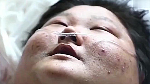 生命缘:540斤的肥胖男,术后成功减重96斤,整个人大变模样!