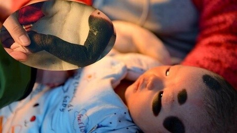 河北女婴患罕见巨型兽皮痣 全身覆盖黑斑