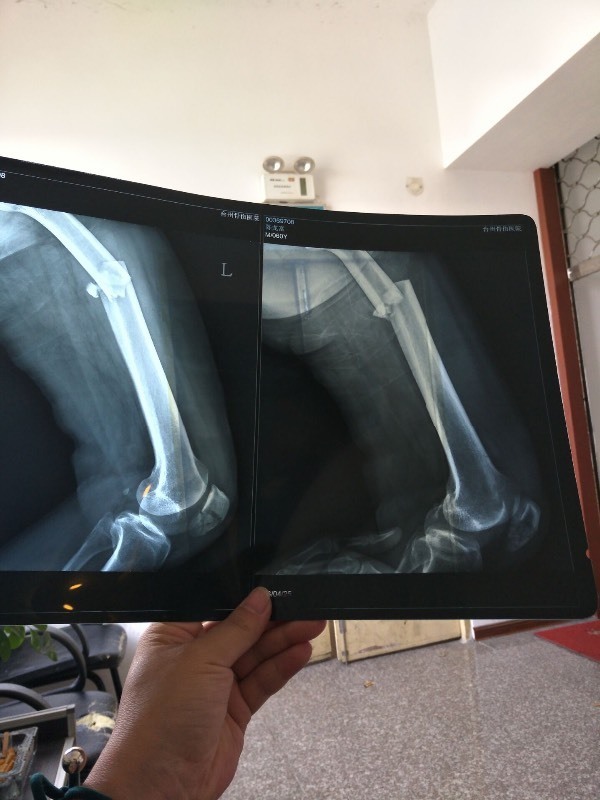 我爸大腿腿骨完全断了和膝盖粉碎性骨折 还有生殖器旁边的骨头有点裂