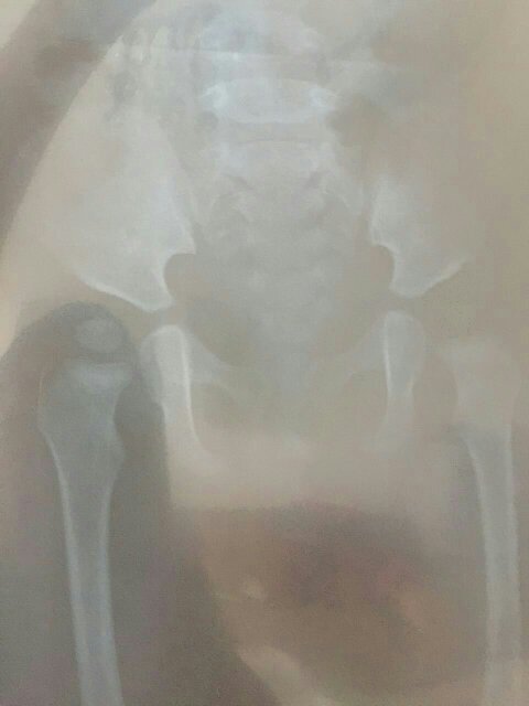 十个月婴儿髋关节骨骨化中心左侧明显小于右侧