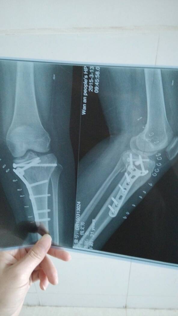 本人左腿胫骨平台粉碎性骨折,手术治疗后一周拍的片子