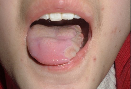 舌根口腔溃疡图片