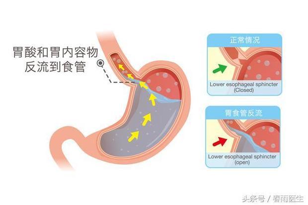 胃疼,反酸,烧心,得了胃食管反流该怎么办?