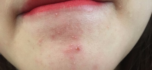 这几天下巴,嘴角,鼻翼两边长了好多白色小脓包,怎么回事?