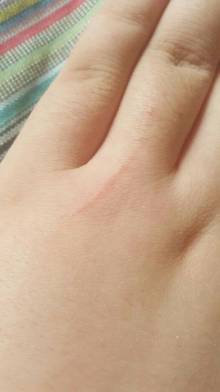 被狗无意间抓了一口子有事没,当时用肥皂清理