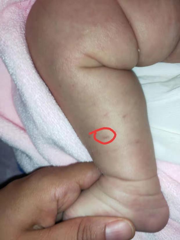 请问新生儿腿上皮下红斑是什么情况?